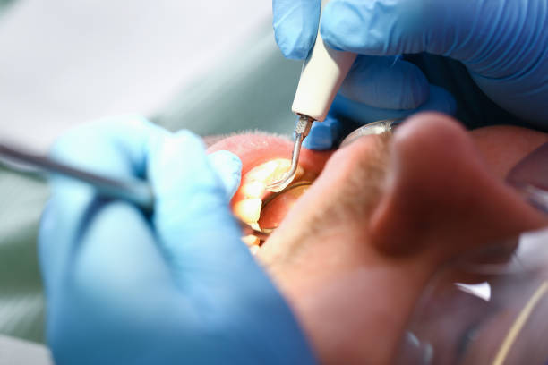 Best Emergency Dental Care for Broken or Chipped Teeth in Schwenksville, PA